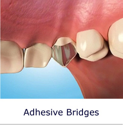 Adhesive Bridges